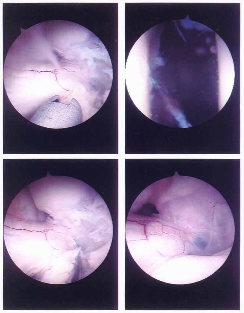 torn ACL inside David's knee