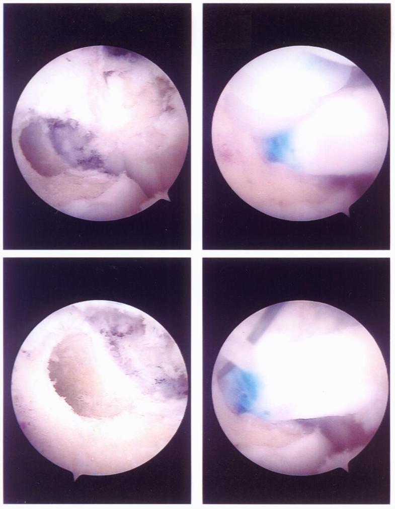 This show the holes drilled in the bone inside David's knee