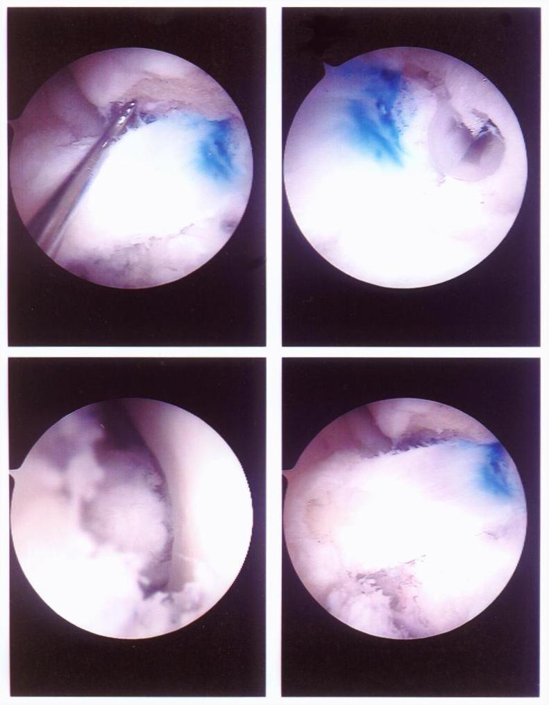The anterior crucial ligament (ACL) inside David's  knee