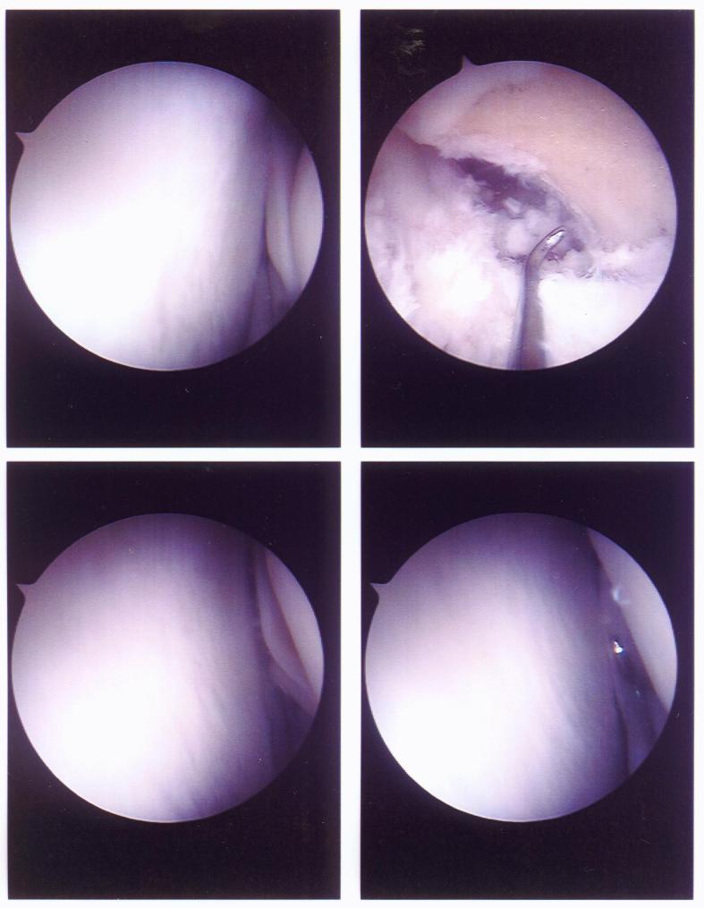 torn meniscus inside David's  knee